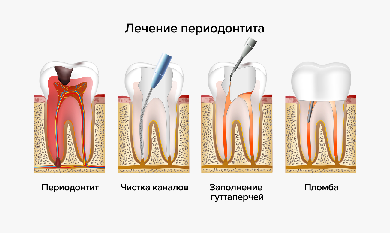 Эндолечение зубов в стоматологии схема